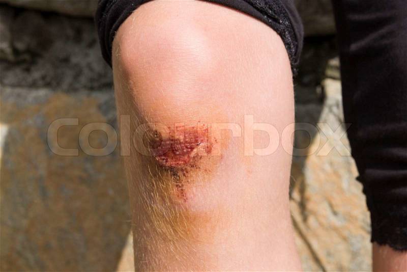 Close up image of a knee with wound, stock photo