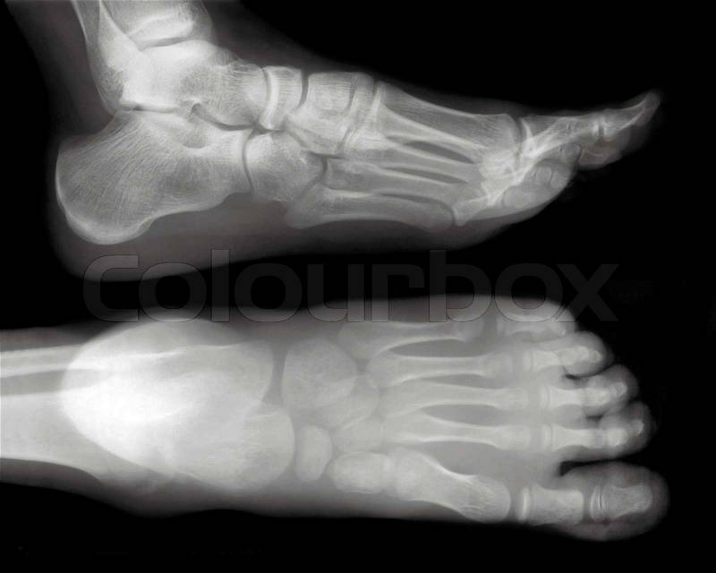 Foot fingers exposed on x-ray black and white film, stock photo