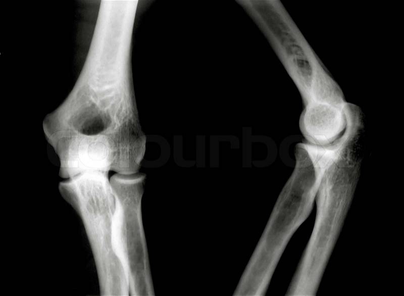 X-Ray picture of knees front and side view, stock photo