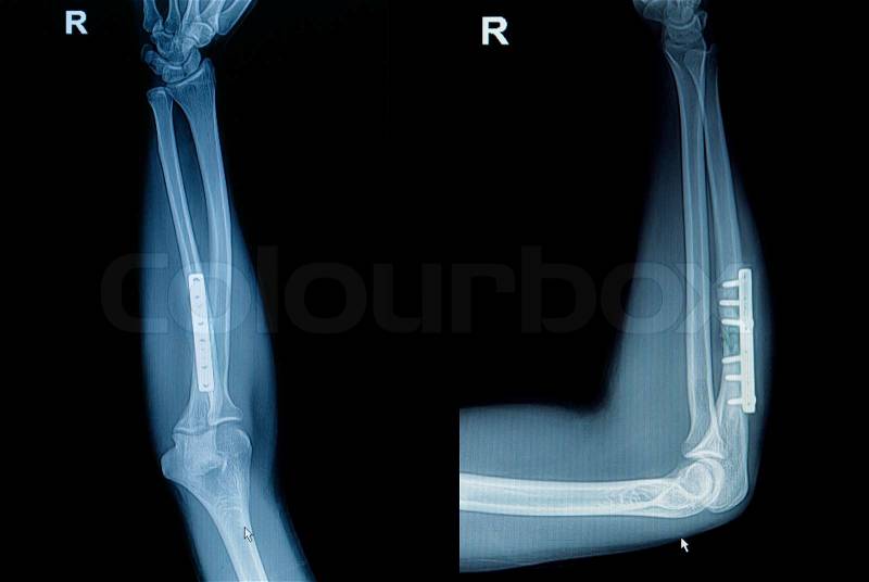 Film x-ray wrist fracture : show fracture radius bone (forearm's bone) with inserted plate and screw, stock photo