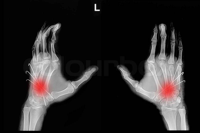Film x-ray of hand fracture : show fracture metacarpal bone insert with k-wire (Kirschner wire), stock photo