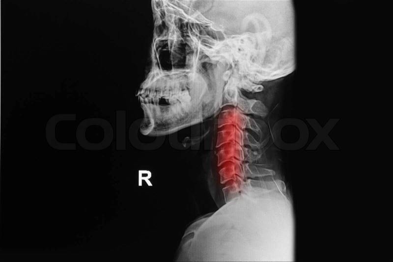 Nox-ray image of cervical spine, neck injury x-ray image description, stock photo