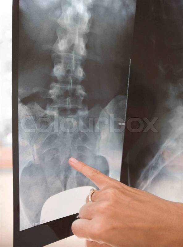 Cropped image of a female hand pointing at an x-ray film, stock photo