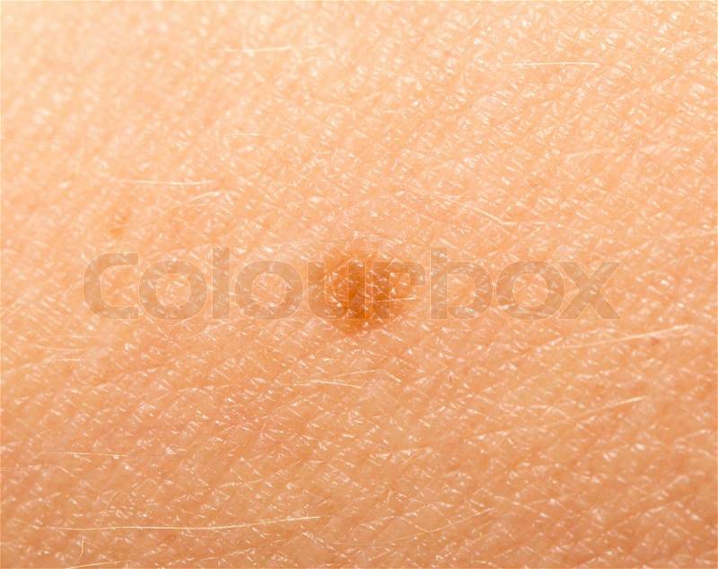 Mole on the human skin, stock photo
