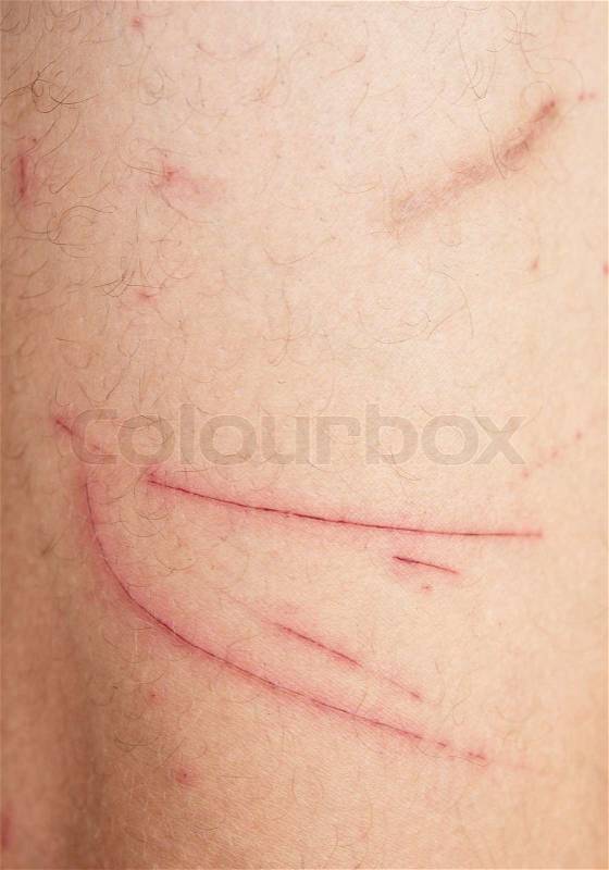 Close up of wound on human skin, stock photo