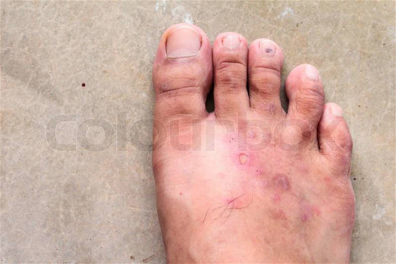 Closeup skin athlete’s foot psoriasis fungus, hong kong foot, foot disease, stock photo
