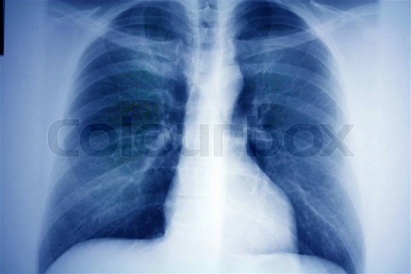 X-ray of a lung. Photo icon for health and disease, stock photo