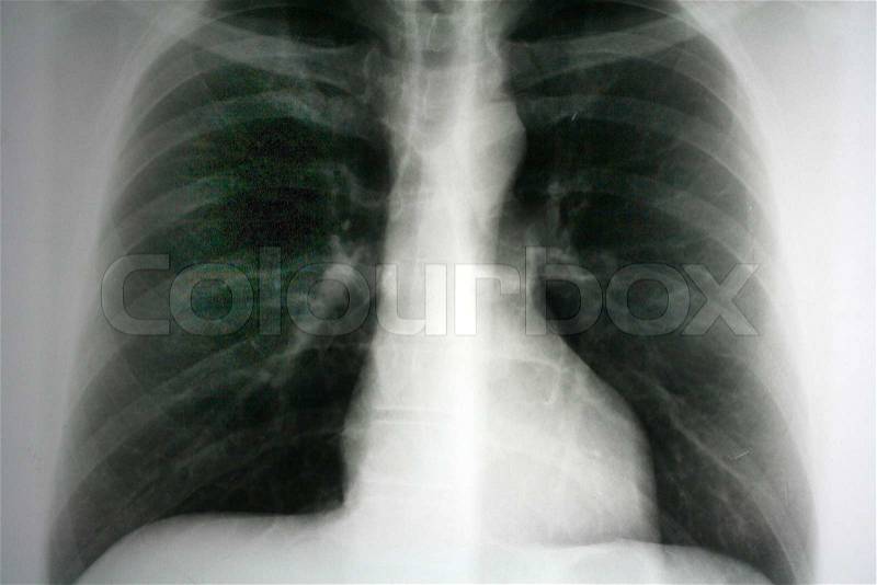 X-ray of a lung. Photo icon for health and disease, stock photo