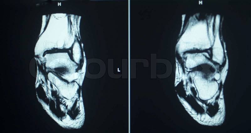 MRI magentic resonance imaging nuclear scanning scan test results ankle injury photo, stock photo