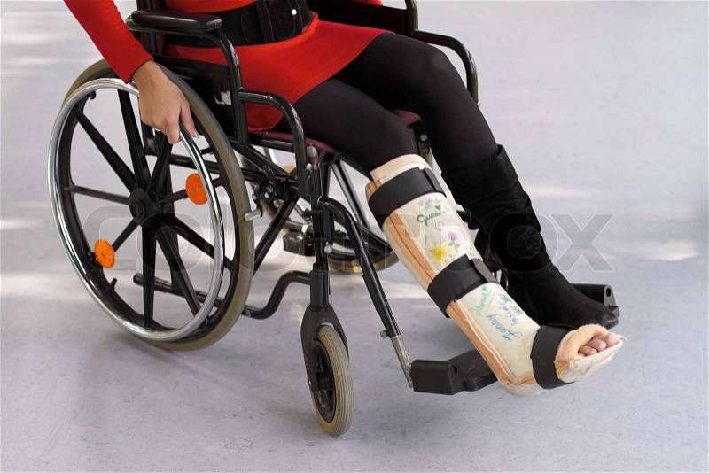 Young woman with leg cast, stock photo