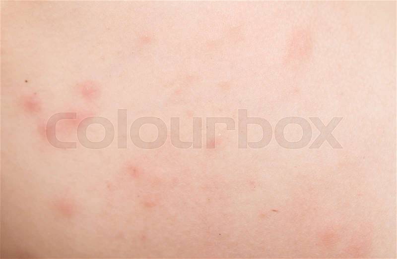 Rash on human skin, stock photo