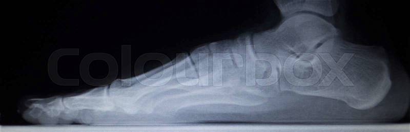 X-ray orthopedic medical CAT scan of painful foot injury in traumatology hospital clinic showing load weight bearing, stock photo