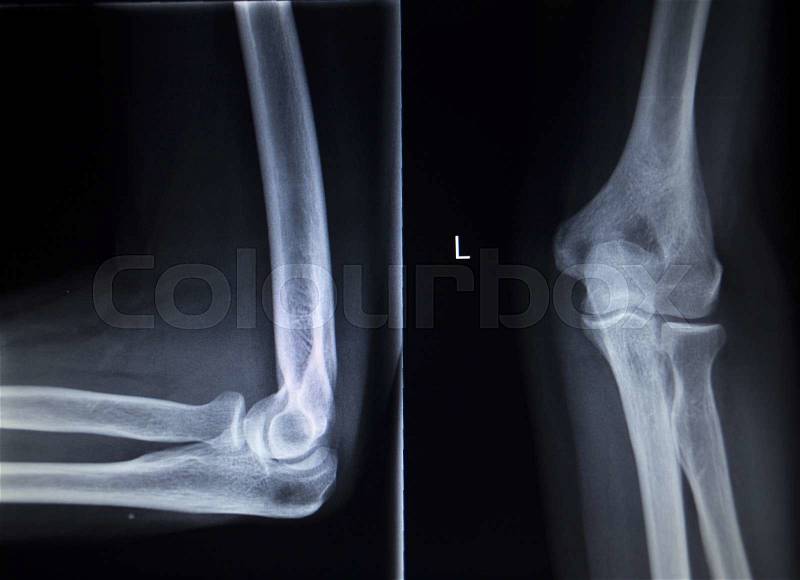 X-ray orthopedic medical CAT scan of painful tennis elbow injury in Traumatology hospital clinic, stock photo