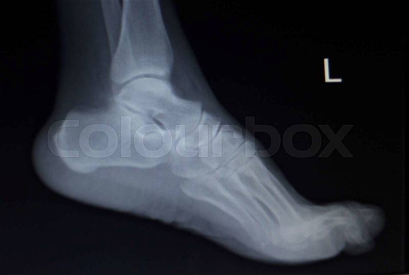 X-ray orthopedic medical CAT scan of painful foot injury in traumatology hospital clinic, stock photo