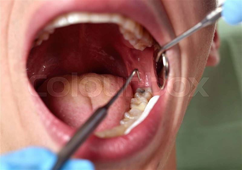 Patient open mouth before oral inspection with hook and mirror, stock photo