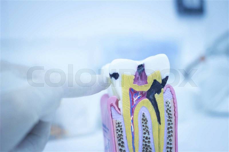 Dental tooth model cast showing decay casing pain, enamel and roots in profile interior of tooth photo, stock photo