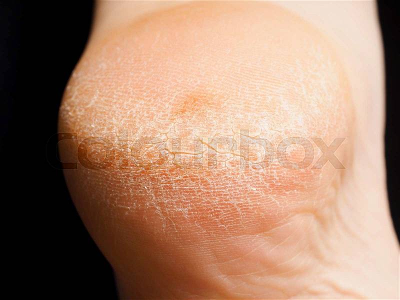 Closeup of cracked dry skin on heel isolated towards black, stock photo