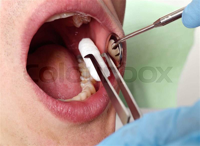 The dentist inserts swab into patient\'s mouth, stock photo