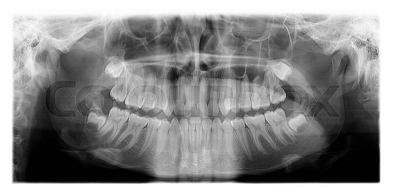 Panoramic dental X-Ray, the human skull and Teeth, stock photo