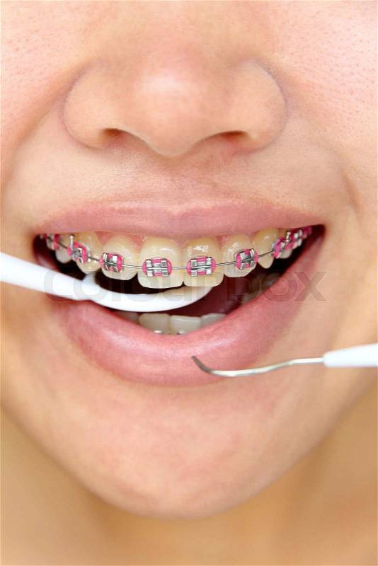 Girl smiling with braces on teeth,dental concept, stock photo