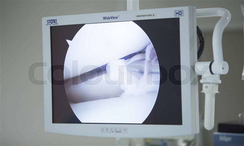Traumatology orthopedic surgery hospital emergency operating room prepared for arthroscopy operation showing screen to view micro camera images, stock photo