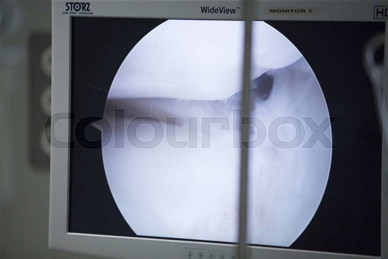Traumatology orthopedic surgery hospital emergency operating room prepared for arthroscopy screen operation photo, stock photo