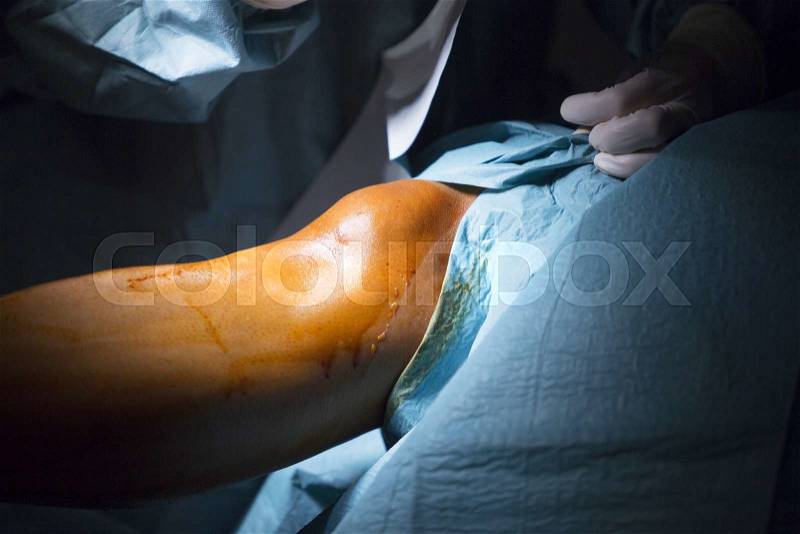 Traumatology orthopedic surgery hospital emergency operating room prepared for knee torn meniscus arthroscopy operation photo, stock photo