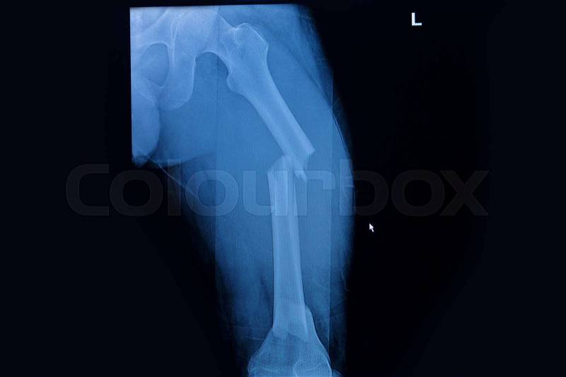 Fractured femur broken leg x-rays image , isolate, stock photo