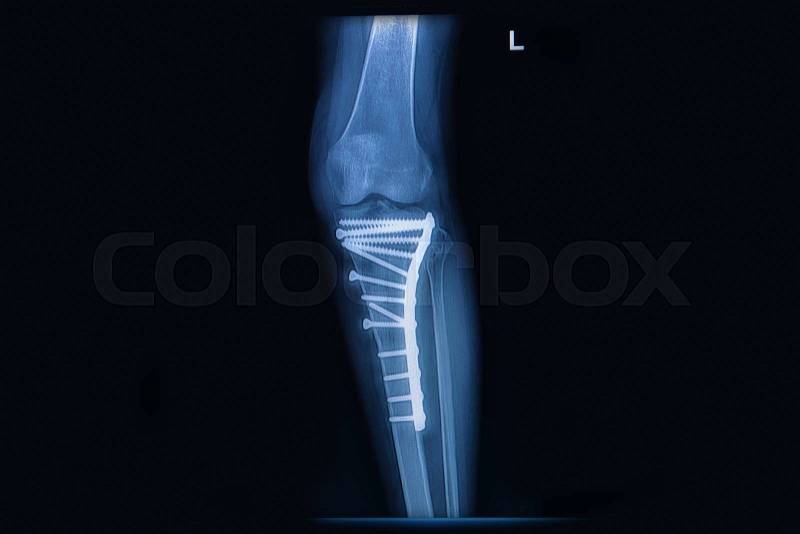 X-ray of fracture tibia(leg bone). tibia bone with internal fixed by plate&screw, stock photo
