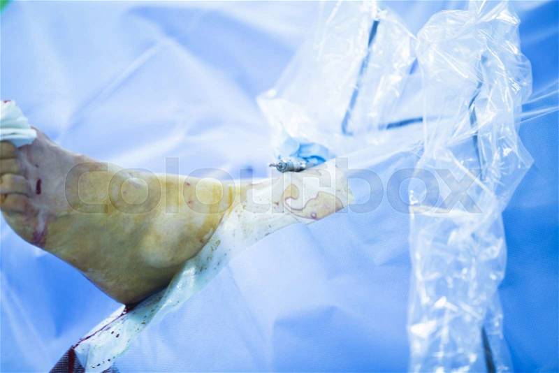 Hospital emergency orthopedics and traumatology surgery operating room medical clinic real life photo in foot, ankle and leg arthroscopy orthopedic operation, stock photo