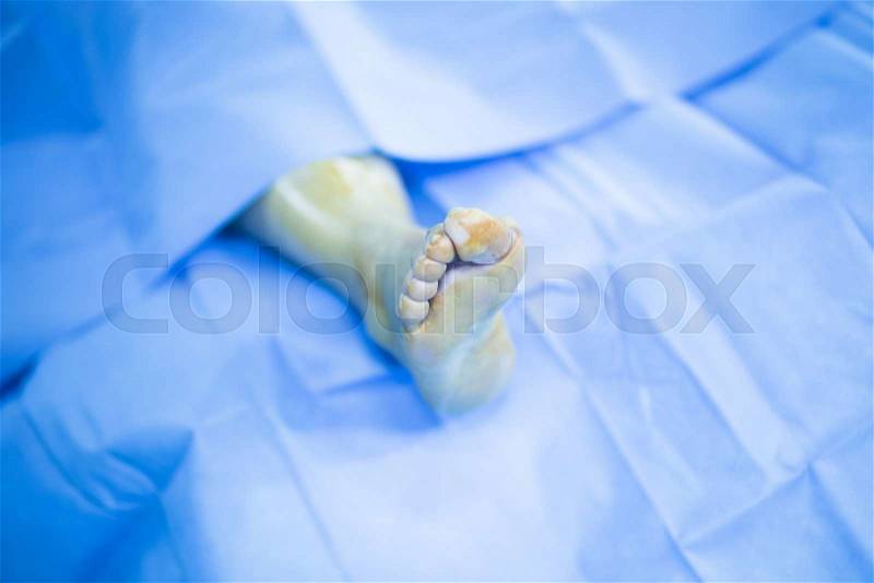 Hospital emergency orthopedics and traumatology surgery operating room medical clinic real life photo in foot, ankle and leg arthroscopy orthopedic operation, stock photo