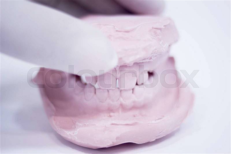 Dental mold dentist clay teeth plate ceramic colored cast model showing tooth decay and gums of patient in dental clinic surgery for diagnosis and treatment held in sterile glove hand of dentist, stock photo