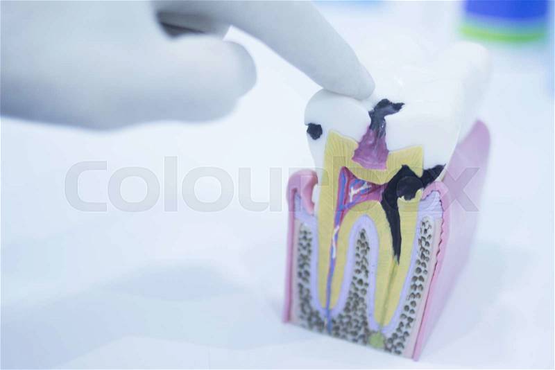 Dental tooth model cast showing decay causing pain and toothache, enamel and roots in profile interior of tooth photo in dental clinic surgery office, stock photo