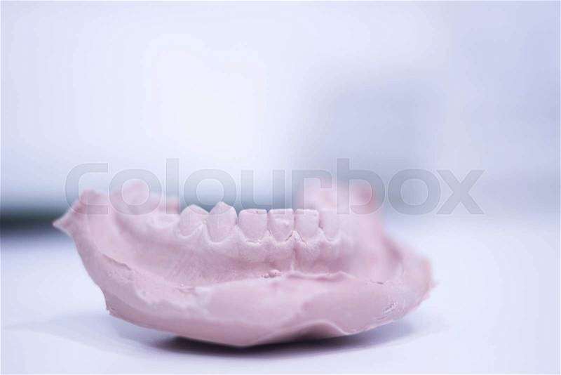 Dental mold dentist clay teeth plate ceramic colored cast model showing tooth decay of patient in dental clinic office surgery used for diagnosis and treatment, stock photo