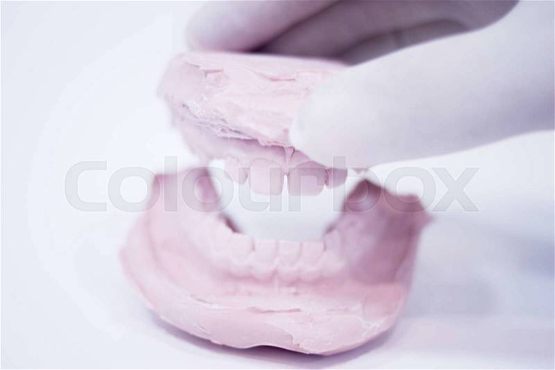 Dental mold dentist clay teeth plate ceramic colored cast model showing tooth decay and gums of patient in dental clinic surgery for diagnosis and treatment held in sterile glove hand of dentist, stock photo