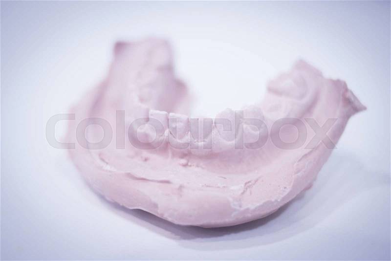 Dental mold dentist clay teeth plate ceramic colored cast model showing tooth decay of patient in dental clinic office surgery used for diagnosis and treatment, stock photo