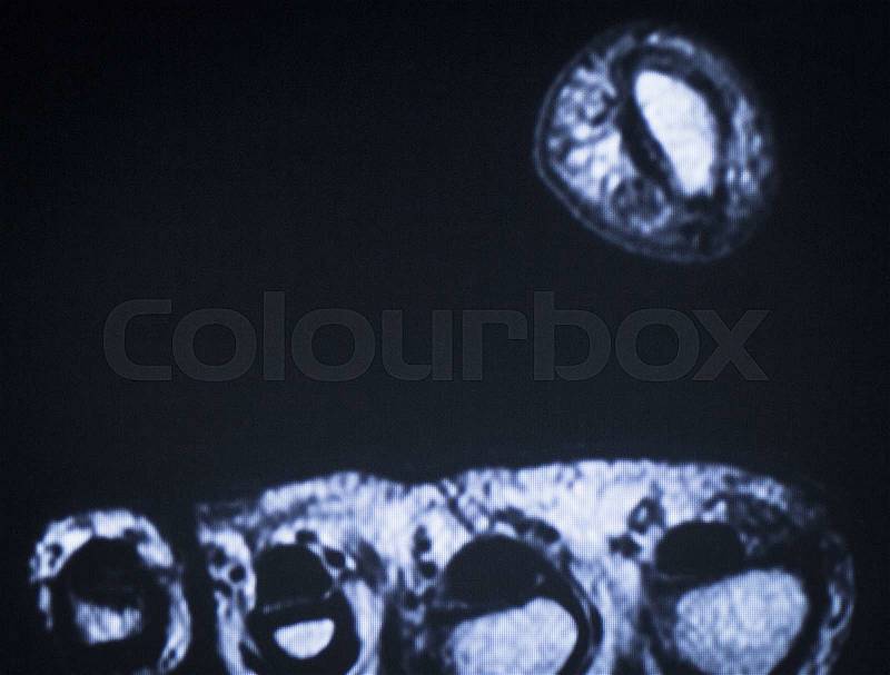 MRI magnetic resonance imaging medical scan test results of foot and toes showing ligaments, cartilege and cross section of bones in human skeleton, stock photo