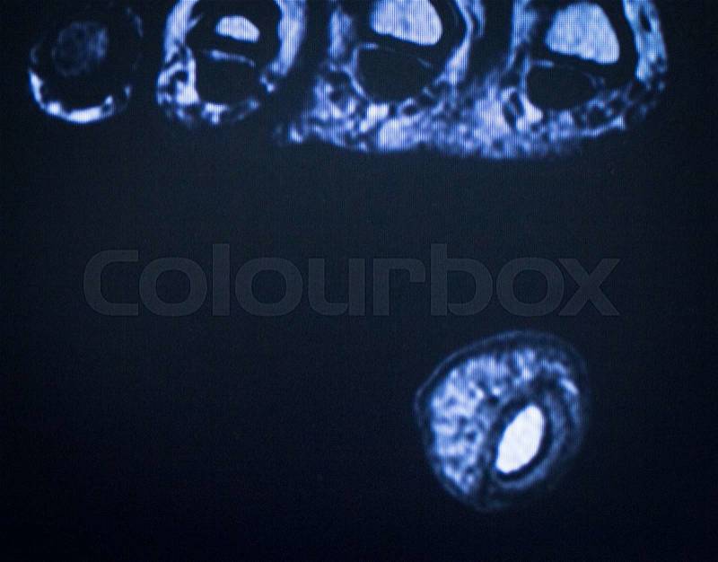 MRI magnetic resonance imaging medical scan test results of foot and toes showing ligaments, cartilege and cross section of bones in human skeleton, stock photo