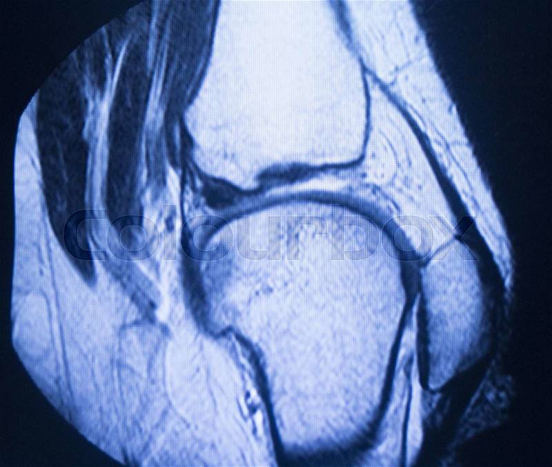 MRI magnetic resonance imaging medical scan test results showing knee joint, meniscus, femur, thigh and calf of leg, ligaments, cartilege and cross section of bones in human skeleton, stock photo
