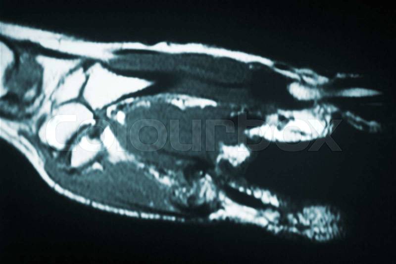MRI magnetic resonance imaging medical scan test results showing ligaments, cartilege and cross section of bones in human skeleton, stock photo