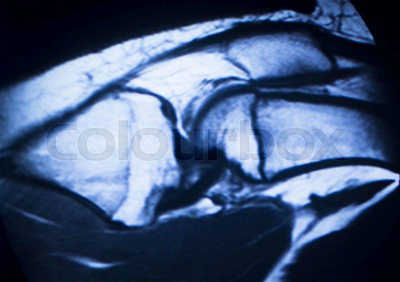 MRI magnetic resonance imaging medical scan test results showing knee joint, meniscus, femur, thigh and calf of leg, ligaments, cartilege and cross section of bones in human skeleton, stock photo
