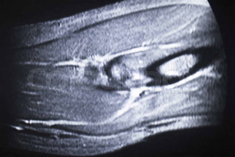 MRI magnetic resonance imaging medical scan test elbow results showing ligaments, cartilege and cross section of bones in human skeleton, stock photo