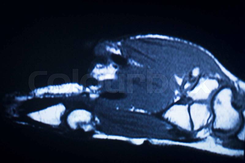 MRI magnetic resonance imaging medical scan test results showing ligaments, cartilege and cross section of bones in human skeleton, stock photo