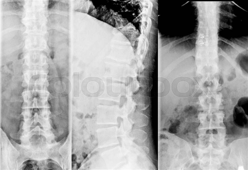 X-Ray Image Of Human Chest for a medical diagnosis, stock photo