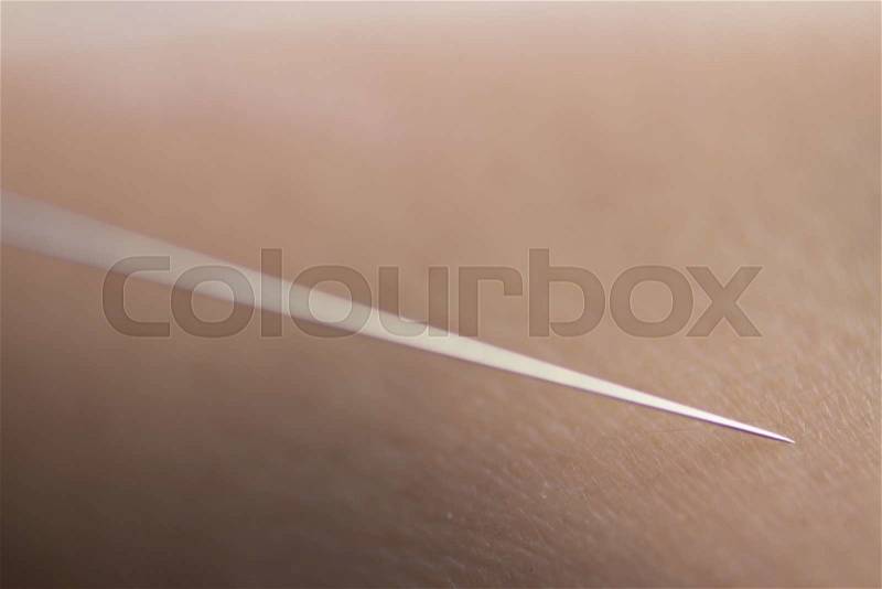Acupuncture needle used for dry needling rehabilitation medical treament for physiotherapy and pain due to physical injury, stock photo