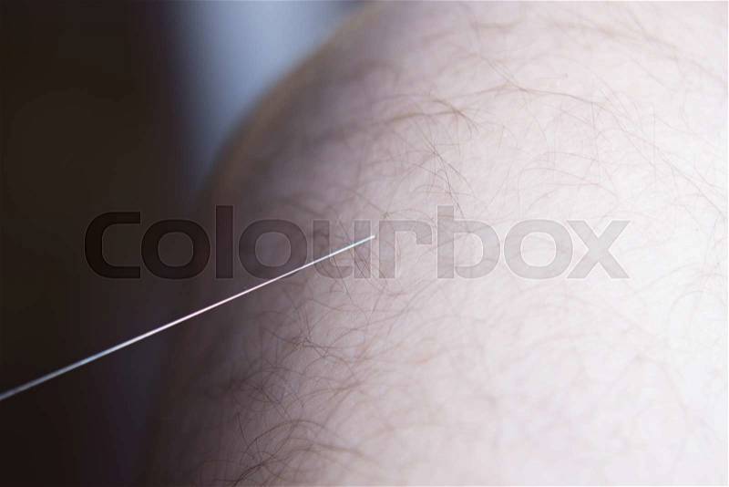 Acupuncture needle used for dry needling rehabilitation medical treament for physiotherapy and pain due to physical injury, stock photo