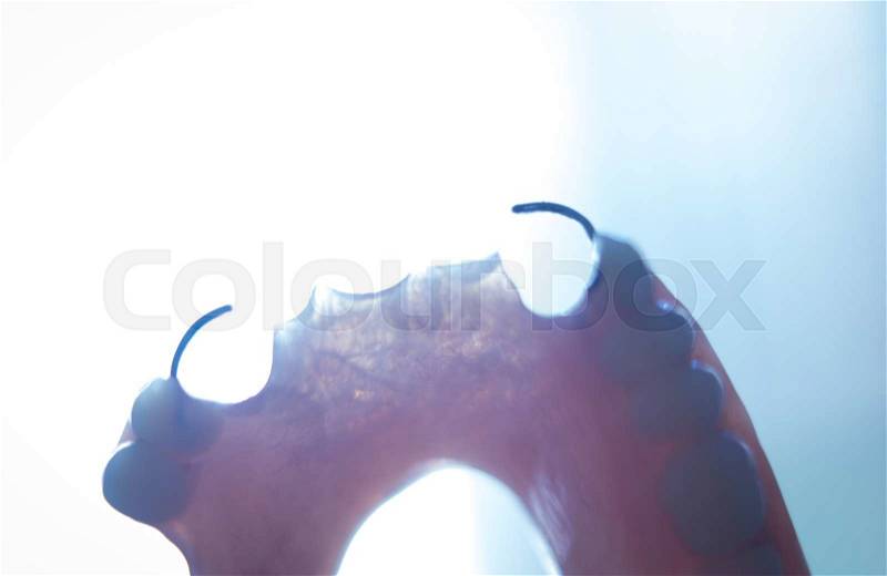 Removable partial denture metal and plastic dental false teeth prosthetics, stock photo