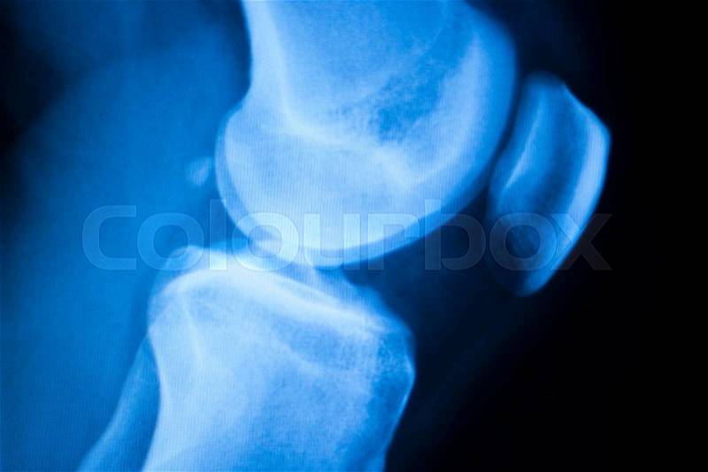 Knee joint meniscus x-ray test scan results photo showing injury and pain for orthopedic surgery and Traumatology surgical treatment, stock photo