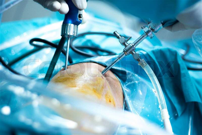 Knee arthroscopy orthopedic surgery operation in hospital operating room photo showing surgeon with arthroscopy camera and probe, stock photo