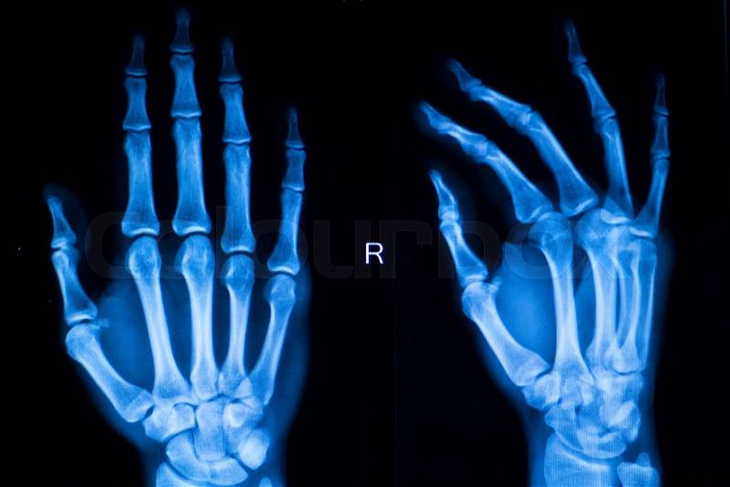 Hand, fingers and thumb hospital x-ray scan test results for joint pain and injury in orthopedic medicine and traumatology clinic, stock photo